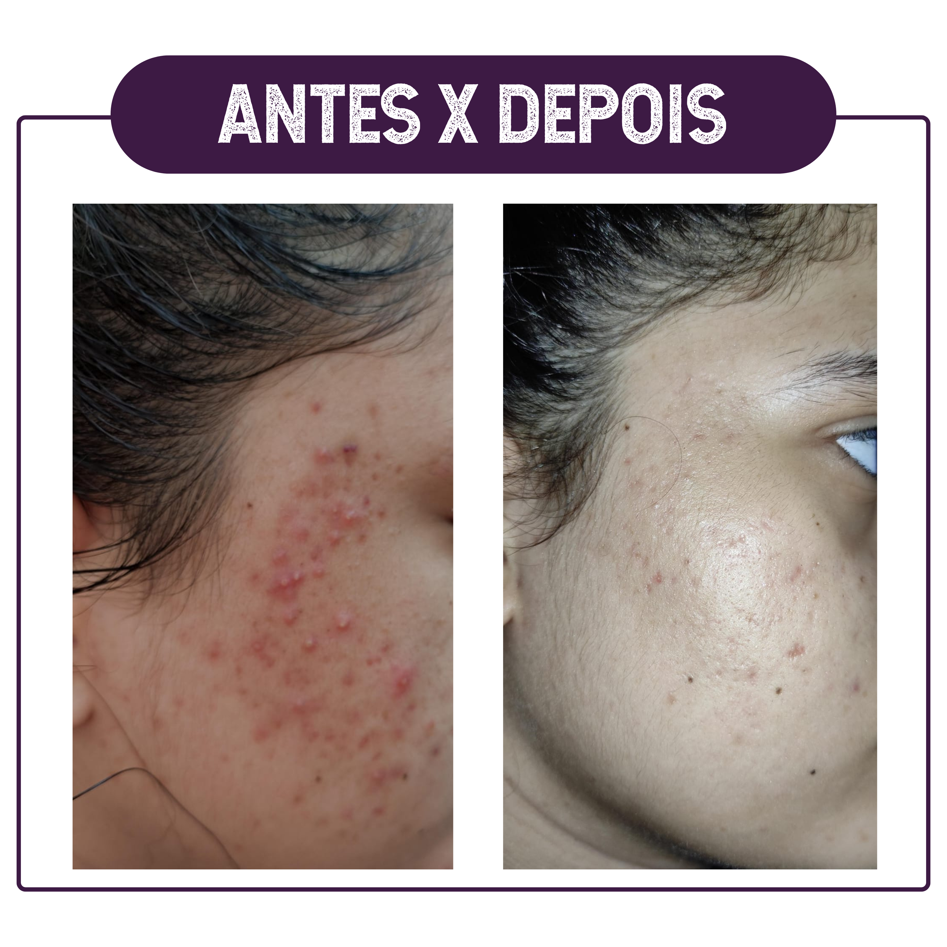 ANTES X DEPOIS4