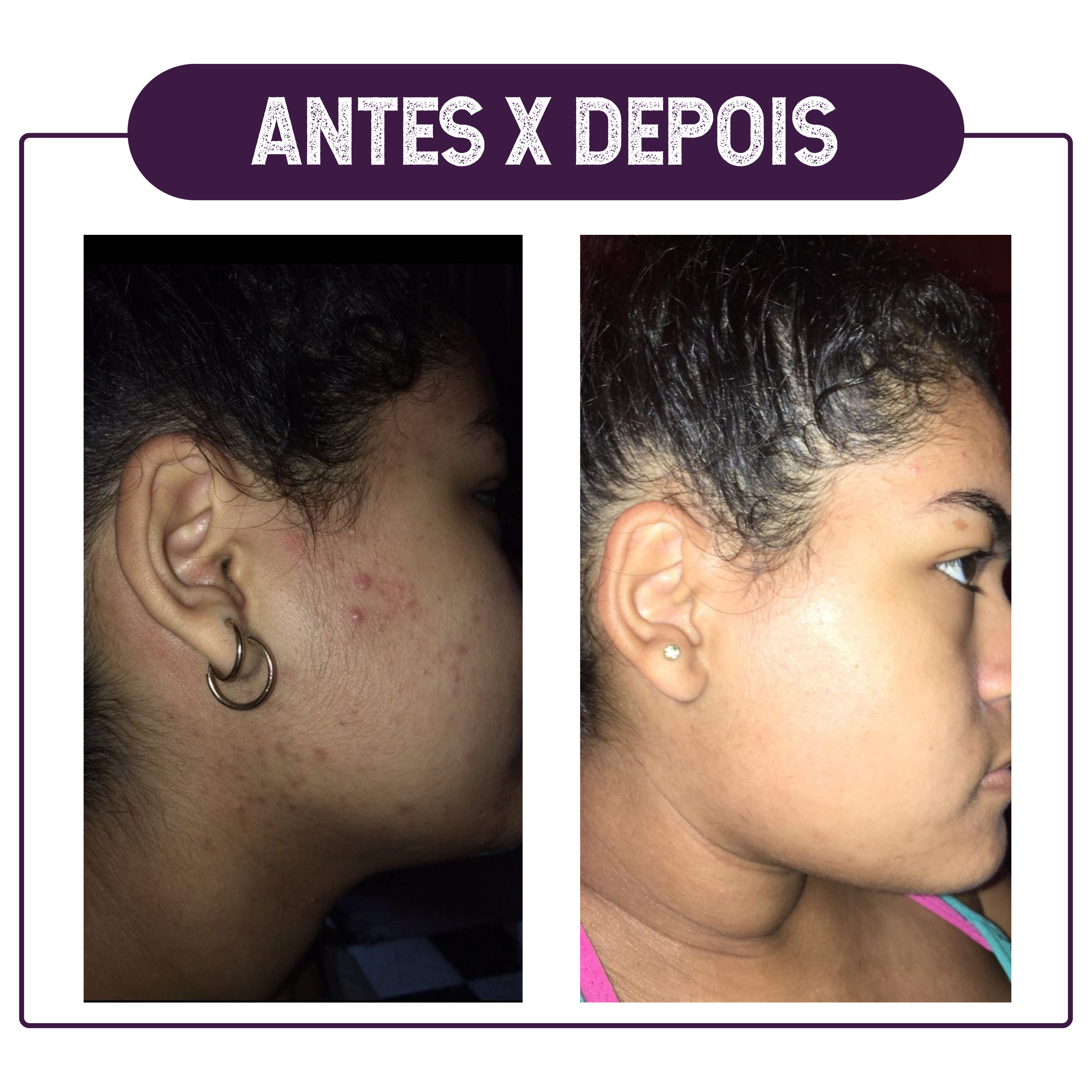 ANTES X DEPOIS5